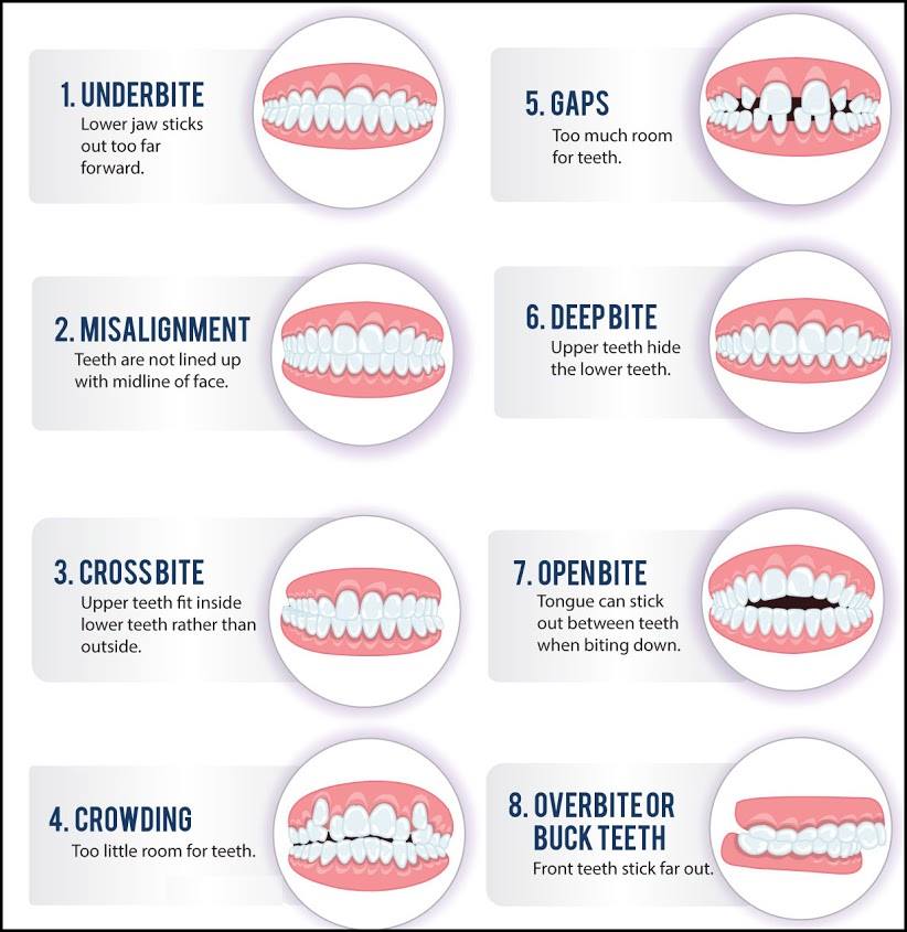 How to Correct an Overbite (or Deep Bite) - Wilkinson Dental